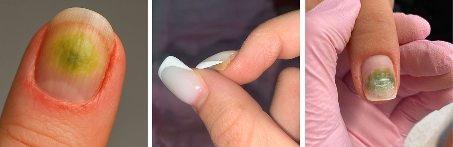 Green bacteria on a nail 